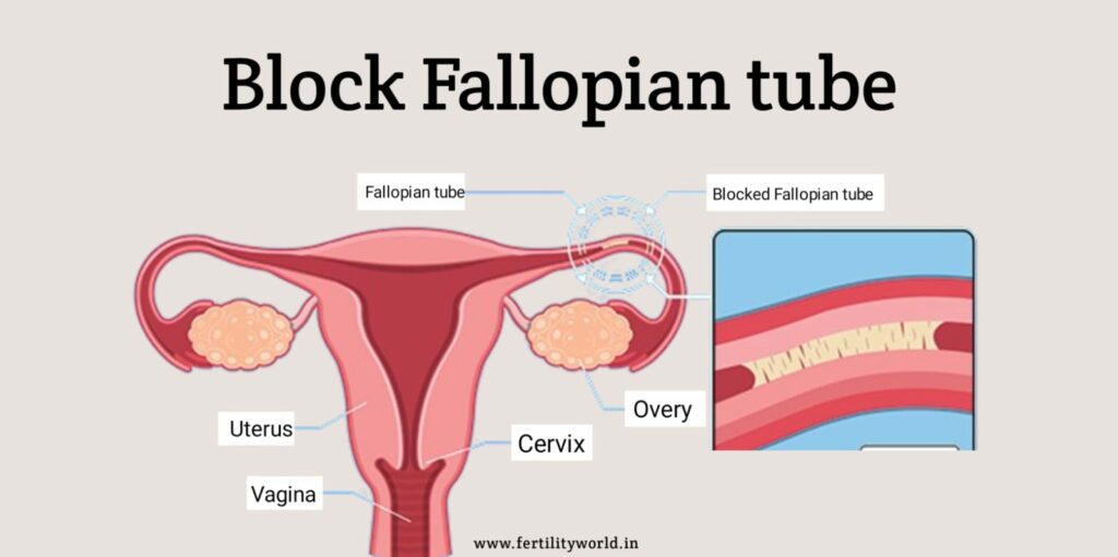 block fallopian tube |fertilityworld