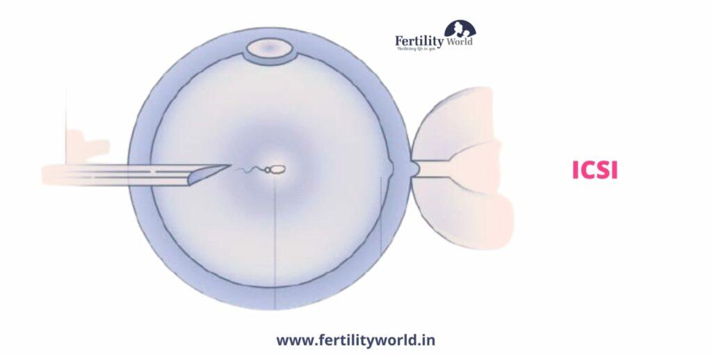 Intracytoplasmic Sperm Injection (ICSI) in Philippines