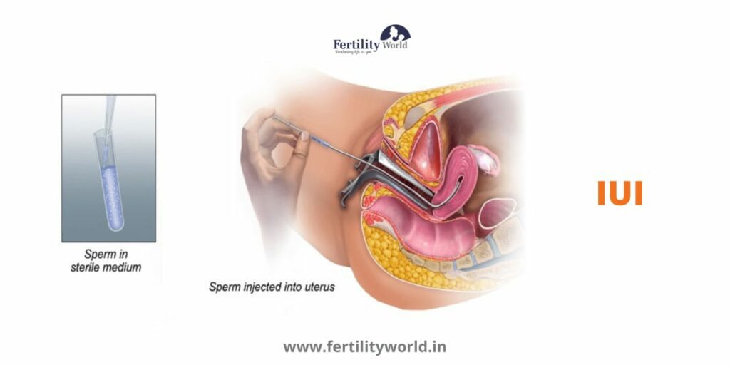 Intrauterine Insemination (IUI) 