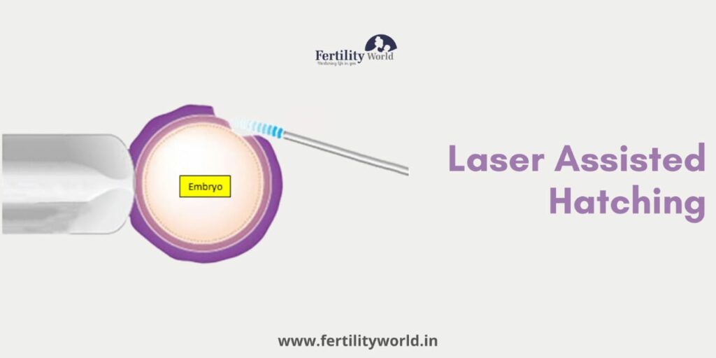 Laser-Assisted Hatching 