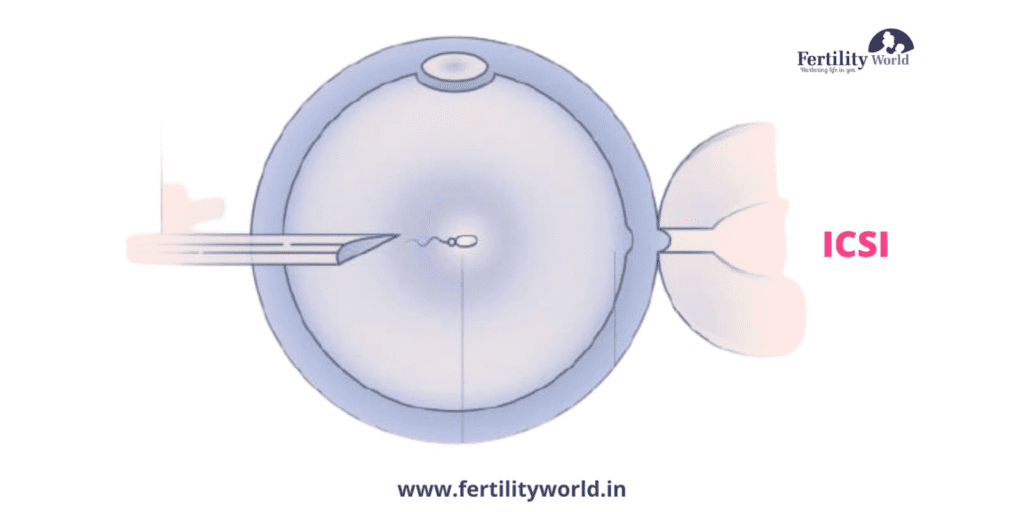 Cost of ICSI treatment in Faridabad