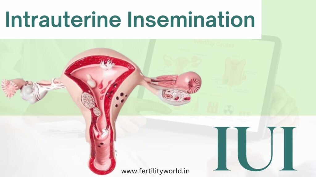 Intrauterine Insemination | Fertilityworld