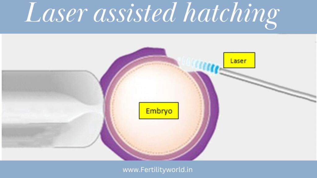 laser-assisted hatching (LAH) | Fertilityworld