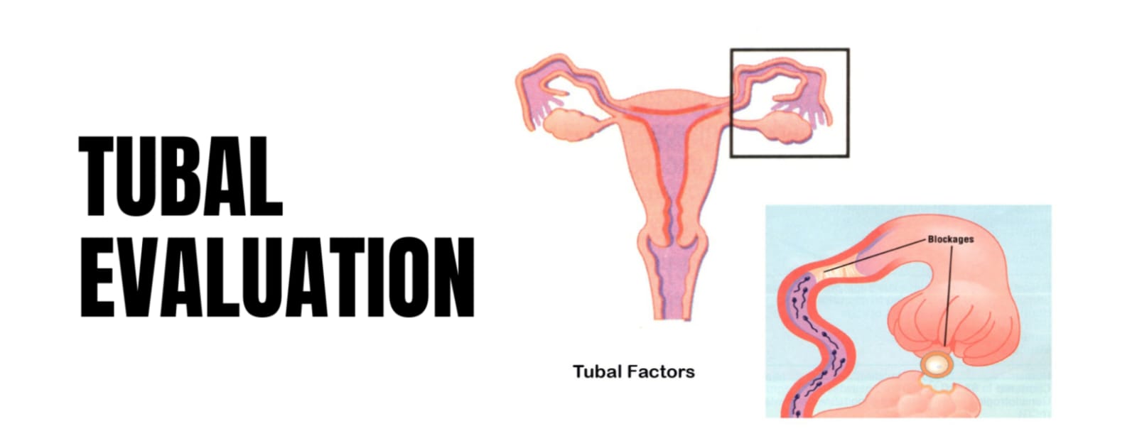 Tubal evaluation